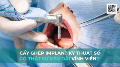 Cấy Ghép Implant Kỹ Thuật Số Có Thật Sự Kéo Dài Vĩnh Viễn?