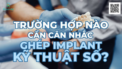 Trường Hợp Nào Cần Cân Nhắc Ghép Implant Kỹ Thuật Số?