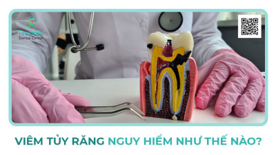 Viêm Tủy Răng Nguy Hiểm Như Thế Nào?