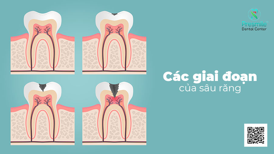 Các giai đoạn của sâu răng